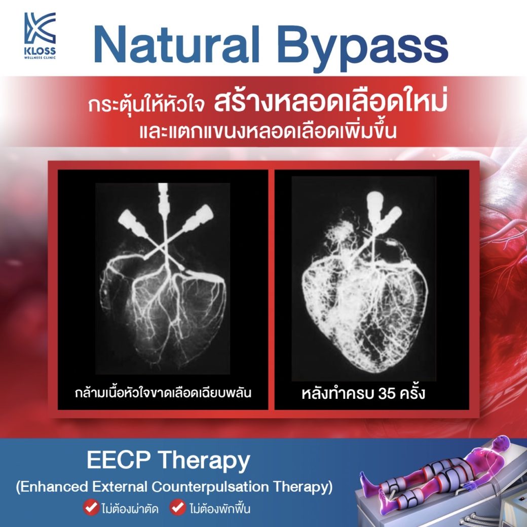 natural bypass